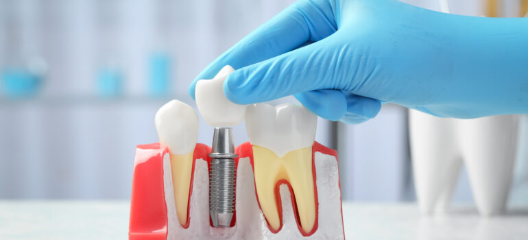 Cómo posicionar una clínica de implantes dentales en Google